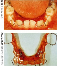 かのう歯科の歯列矯正