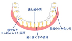 虫歯の治療